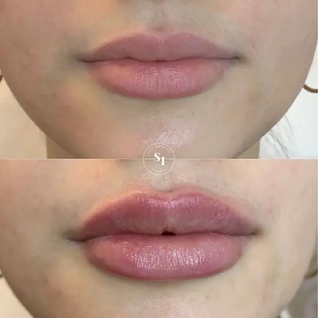 hyaluronic acid lip fillers