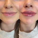 injectables