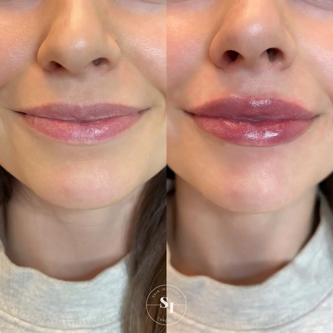injectables
